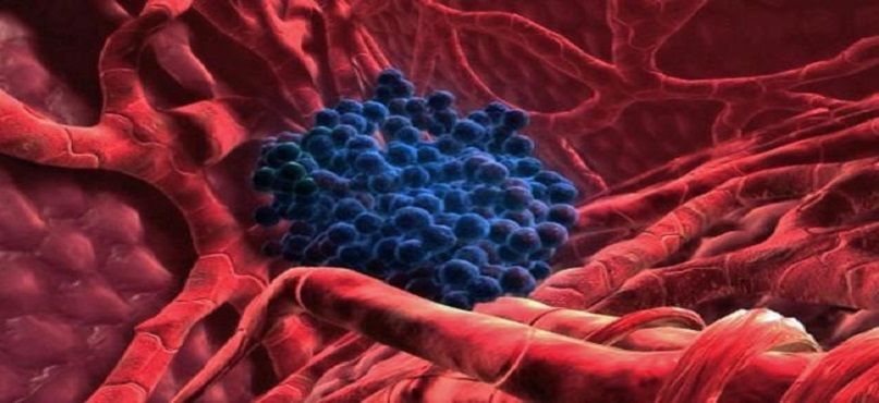 LifEscozul&reg; - Cáncer de útero y cervix