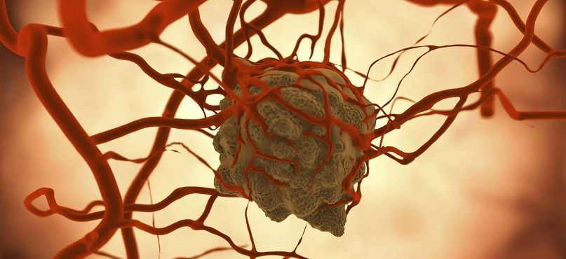 LifEscozul&reg; - Cáncer de amígdala