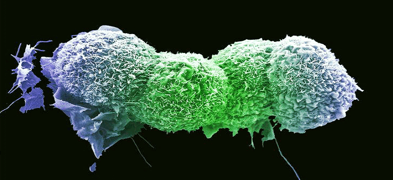 LifEscozul&reg; - Cáncer de tiroides