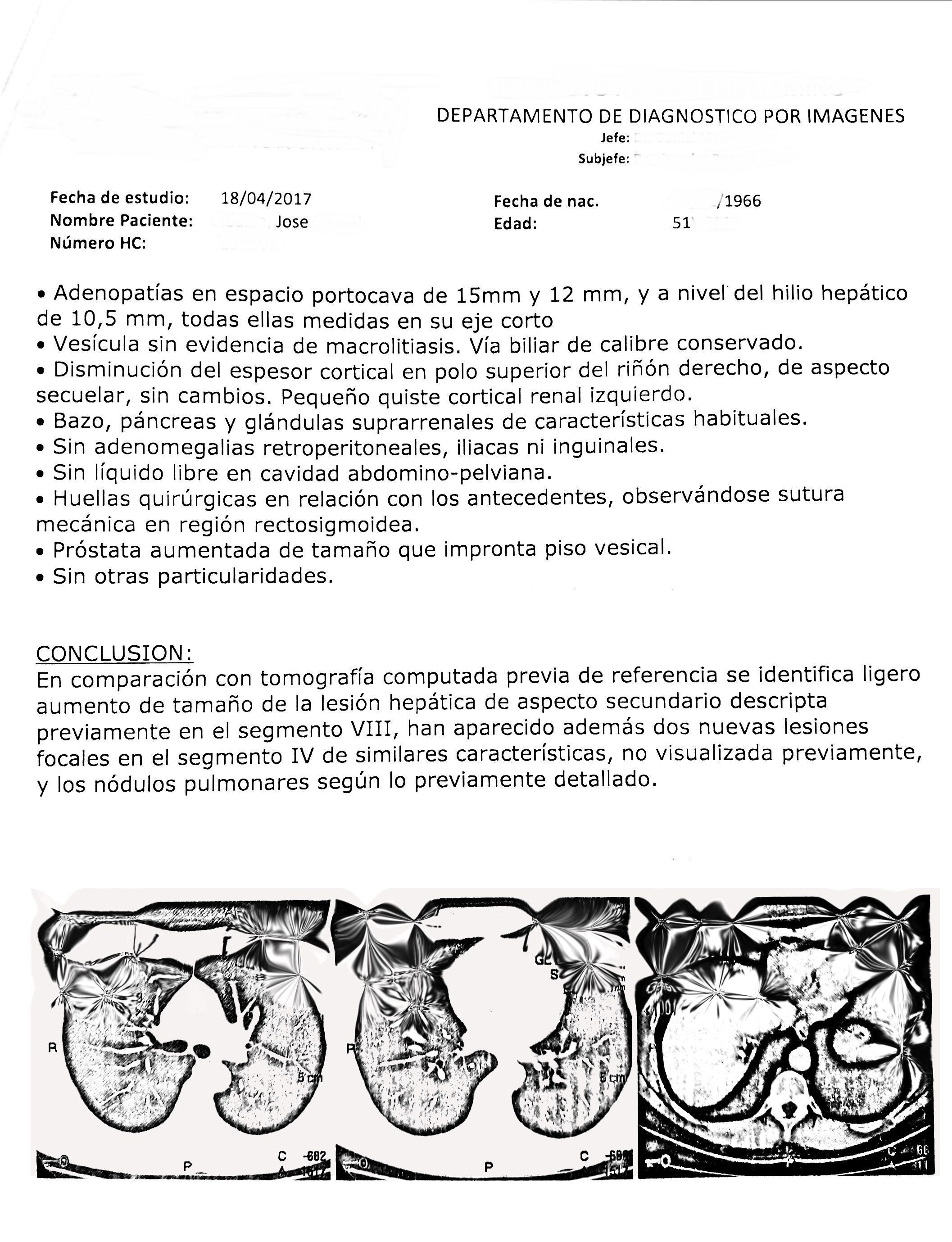 LifEscozul&reg; - José 2 - Cáncer de Cólon